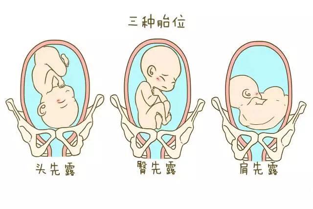 胎位不正怎么判断,如何判定胎位不正