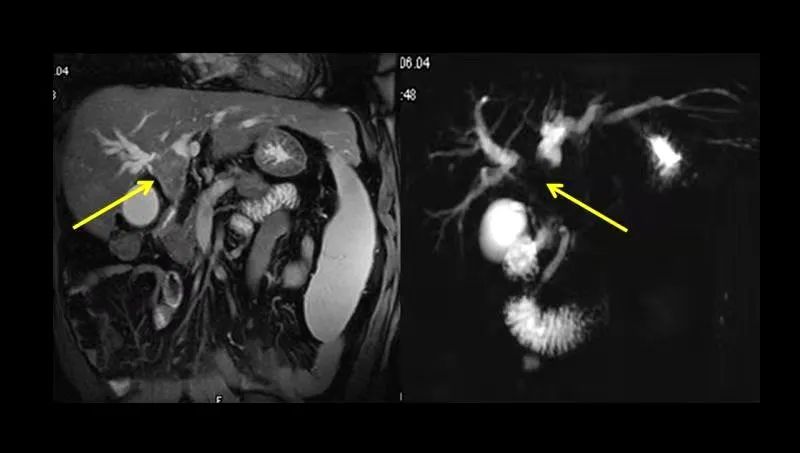 黄疸要做肝脾彩超吗,黄疸需要做颅脑彩超吗