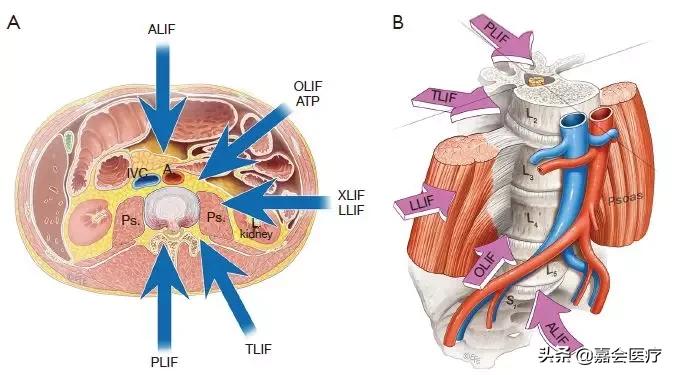 腰椎椎弓崩裂是什么原因造成的,腰痛是犯了什么因果