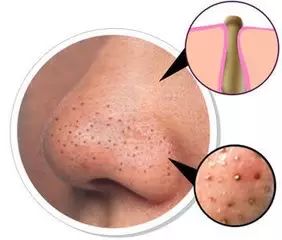 背后长痘痘用什么药膏,喝啤酒背后长痘痘是什么情况