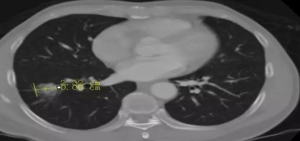 癌症信号早知道,癌症早期信号