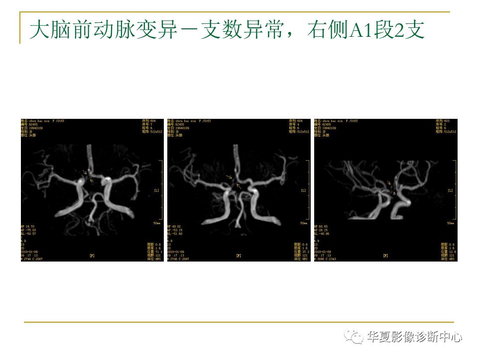 中国人脑立体定向mri应用解剖图谱,脑mri示意图