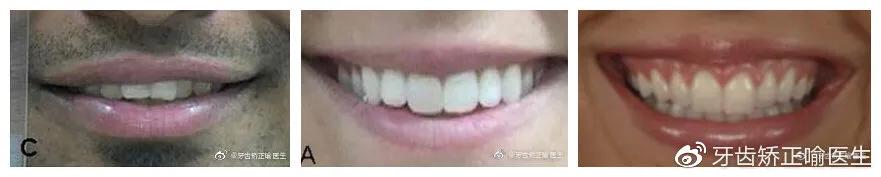宝宝笑起来露牙龈是什么原因,牙齿矫正露牙龈笑怎么办