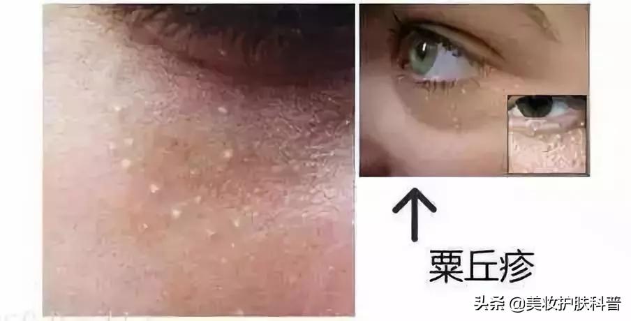 容易长脂肪粒用什么眼霜,为什么一用眼霜就长脂肪粒