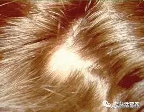 斑秃儿童饮食,饮食油腻会导致斑秃吗