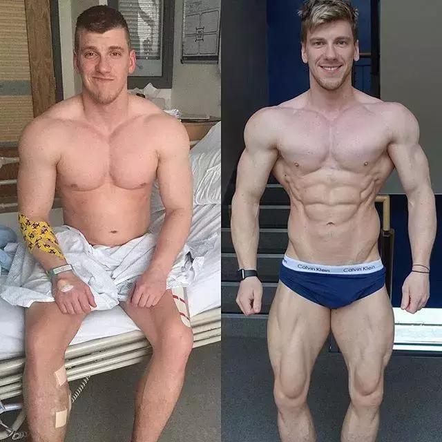 26岁健美冠军小腿静脉爆裂,22岁小伙健身过猛导致内脏撕裂