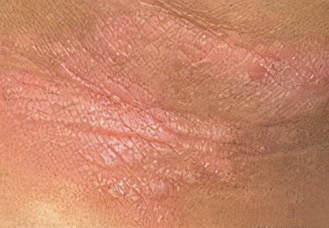 神经性皮炎反复发作，怎样才能摆脱它？