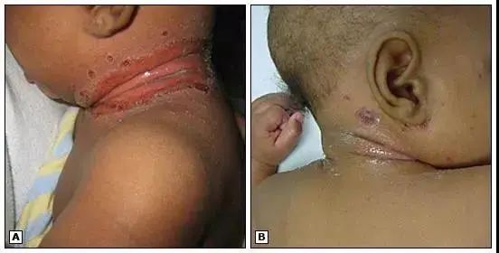 淹脖子溃烂了用什么药,四岁宝宝淹脖子溃烂渗液