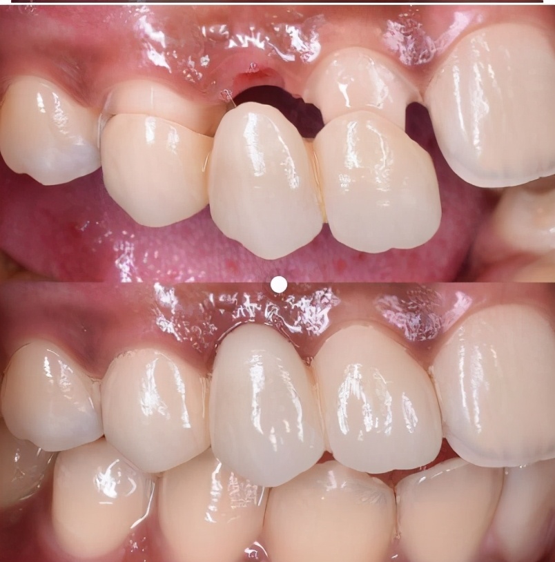 树脂牙和全瓷牙的区别,牙科医生讲座视频大全