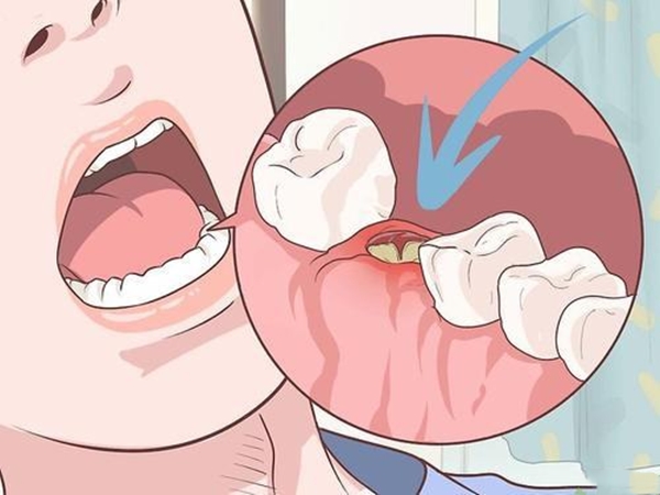 上午种牙下午就能用,上午种植牙下午就可以吃饭