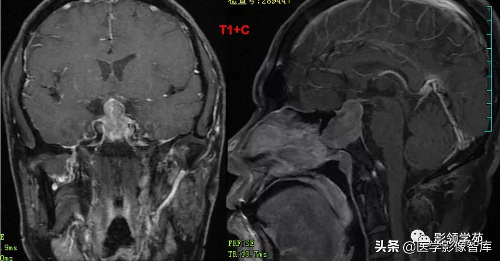 鞍区肿瘤做什么检查得出来,鞍区肿瘤的影像学鉴别
