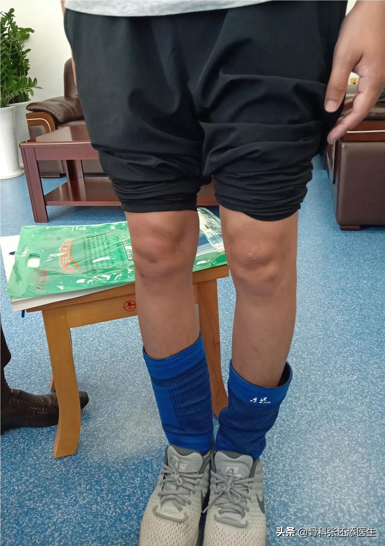 o型腿打篮球的危害,o型腿打篮球是怎么样的