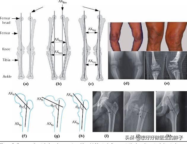 这几招防治膝骨关节炎有效,女性如何预防膝骨关节炎