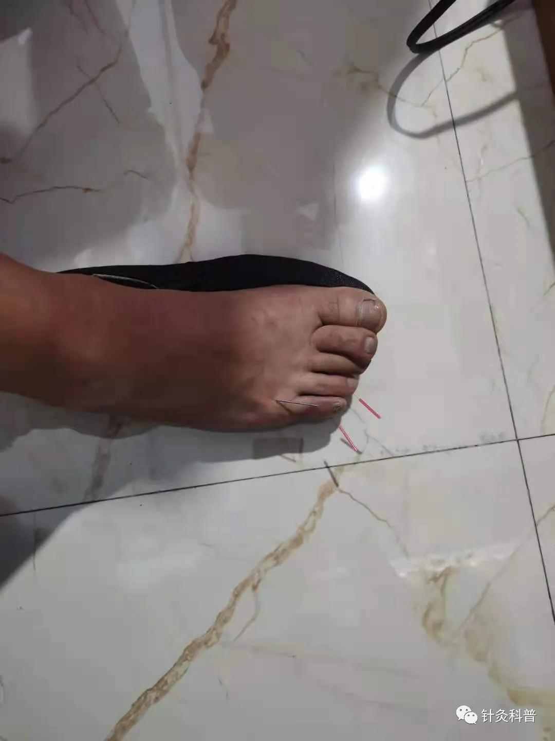 针灸最新疗法300例,传统针灸治疗杂病