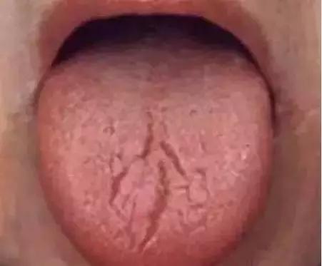 老中医提醒舌头4种异常,舌头一旦出现这个信号马上找中医