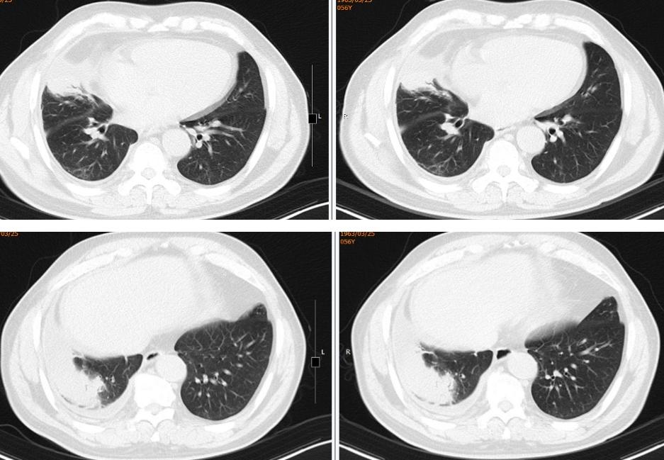 56岁男性发现双肺数百个结节,肺部肿块伴胸腔积液