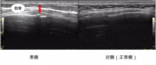 怀疑骨折拍x片还是核磁,肋骨骨折x光片如何看
