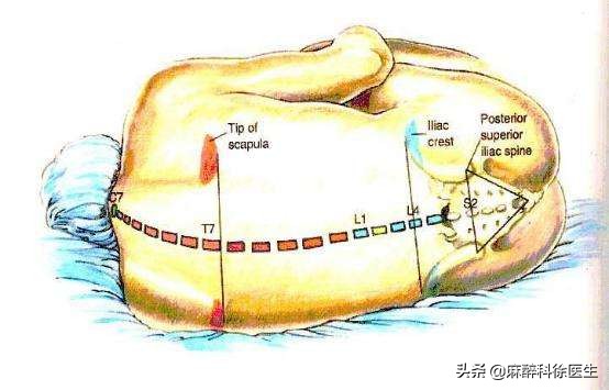 打麻醉是什么体验,半身麻醉多长时间恢复感觉