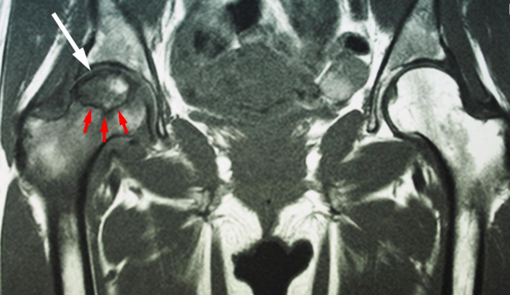 股骨头坏死置换如何避免并发症,股骨头坏死避免吃哪些食物
