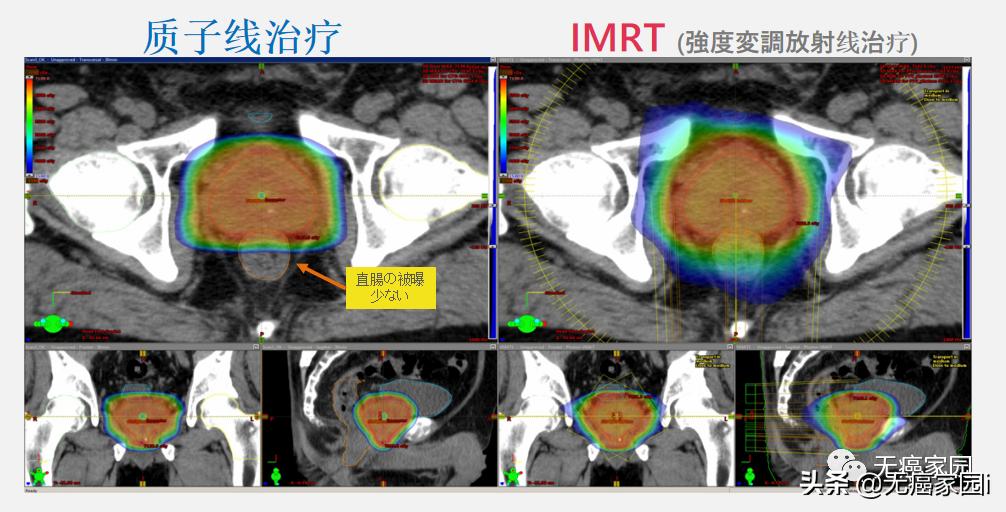 质子治疗手术适合大型肿瘤,肿瘤不能根治吗