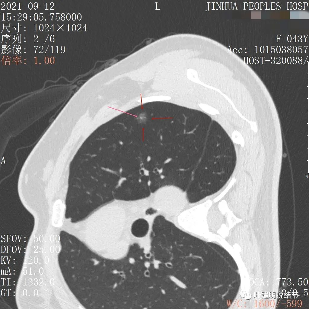 从活检怎么看是非小细胞癌,从病例谈辨证论治