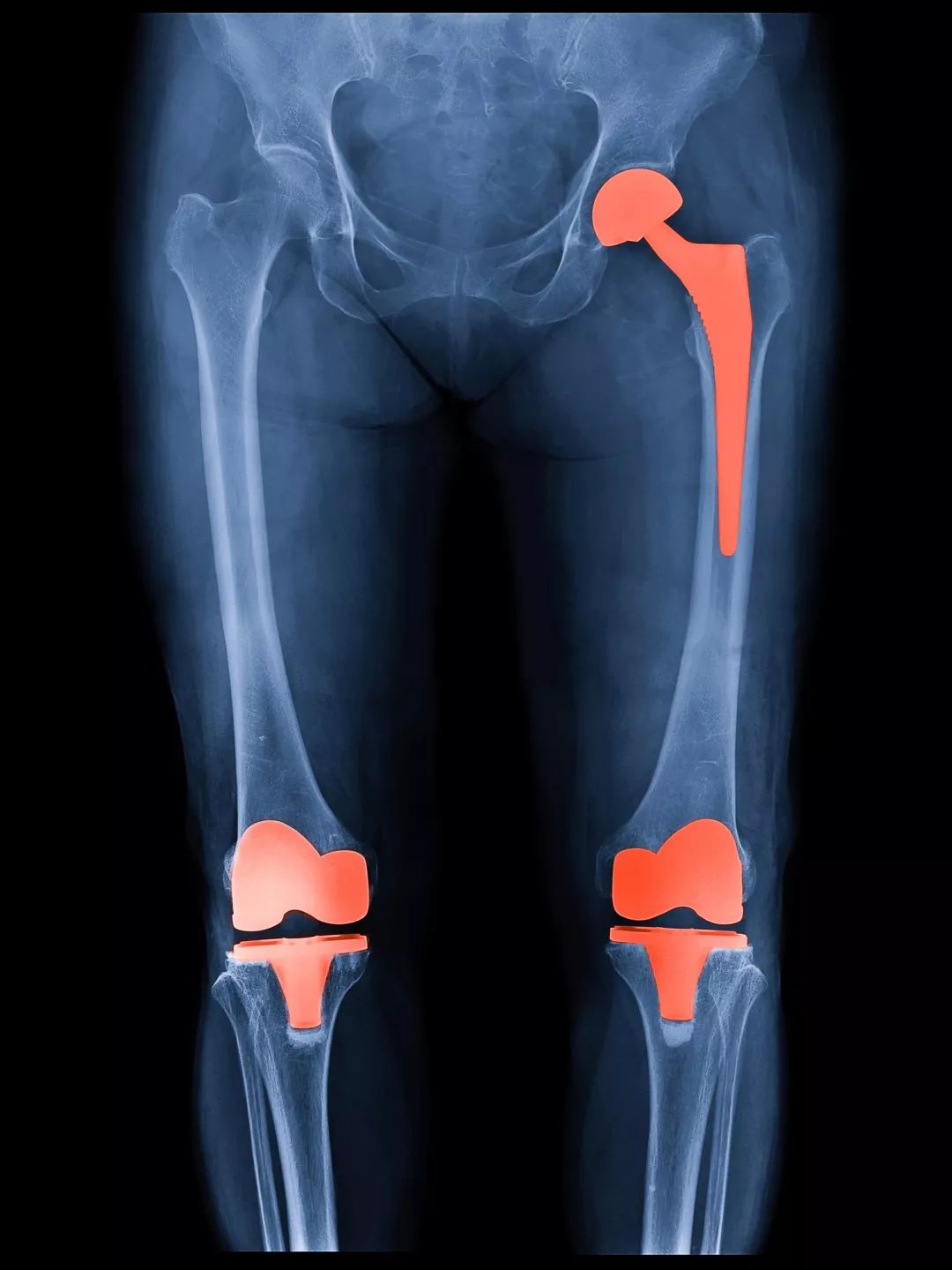 膝盖关节炎骨刺用什么药缓解疼痛,受冷膝盖长骨刺能治好吗