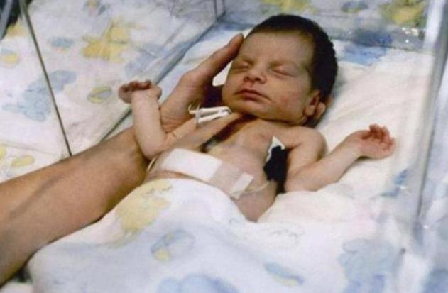 80年代移植狒狒心脏的婴儿,第一个移植狒狒心脏的美国女孩
