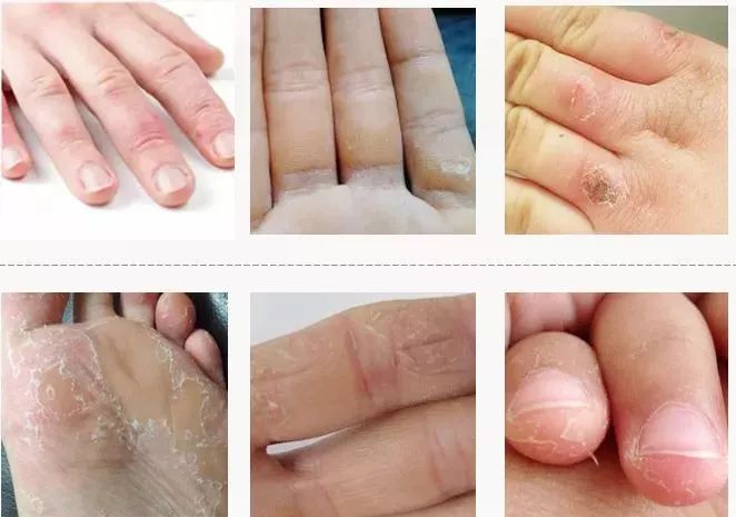 后脚跟干裂护足霜排行榜第一名,护脚霜脚后跟干裂修复霜国货