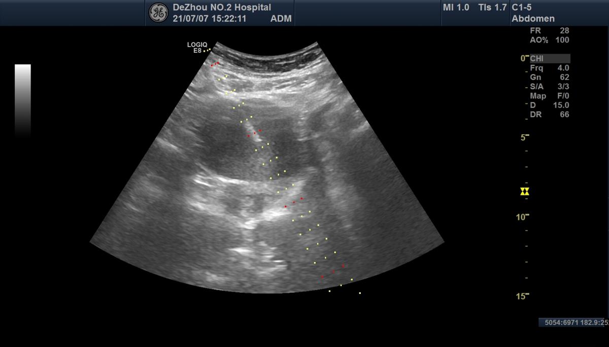 卵巢畸胎瘤和巧克力囊肿,未婚女性卵巢巧克力囊肿