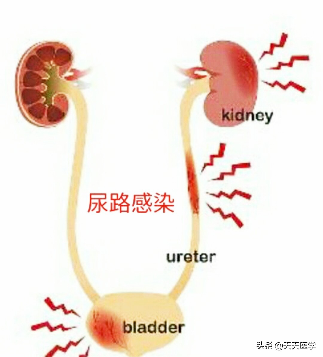 慢性肾盂肾炎的反复发作的原因和预防措施