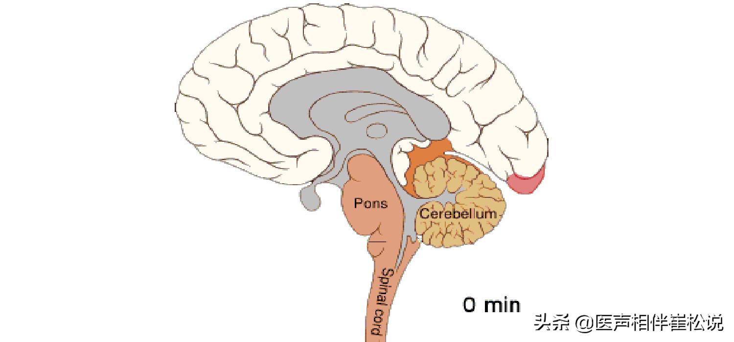 脑梗和腔梗是一回事儿吗,脑梗和腔梗是一回事吗