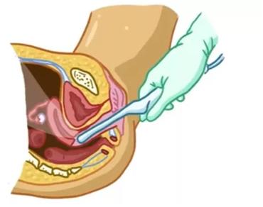 3种迹象，教你辨别宫外孕，产科医生说：及时才能保命