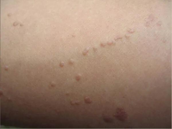 得了乙肝的人身上长红点怎么回事,乙肝病毒携带者身上有一颗颗红点