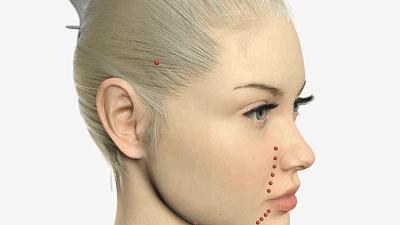 28岁做线雕提升脸部好不好,28岁女人做线雕现状