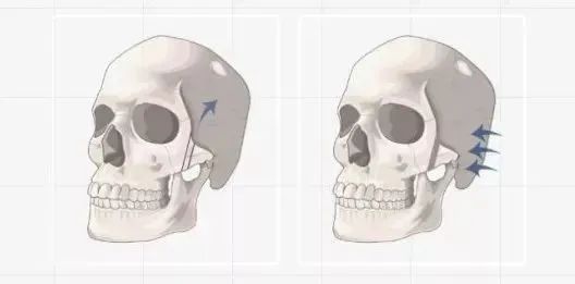 颧骨内推后会下垂么,颧骨内推后会下垂吗