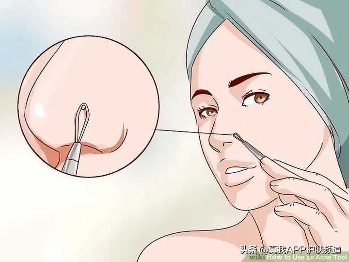 顽固黑头怎么去除最有效,变美小知识黑头怎么去掉