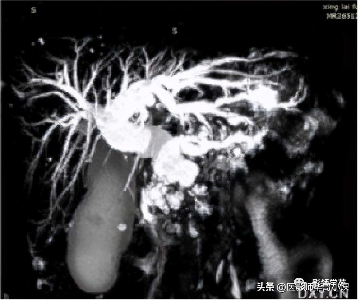 胆总管变异,胆胰管解剖