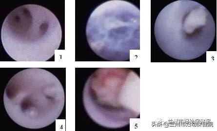 什么叫乳管镜检查,乳管镜检查操作与步骤