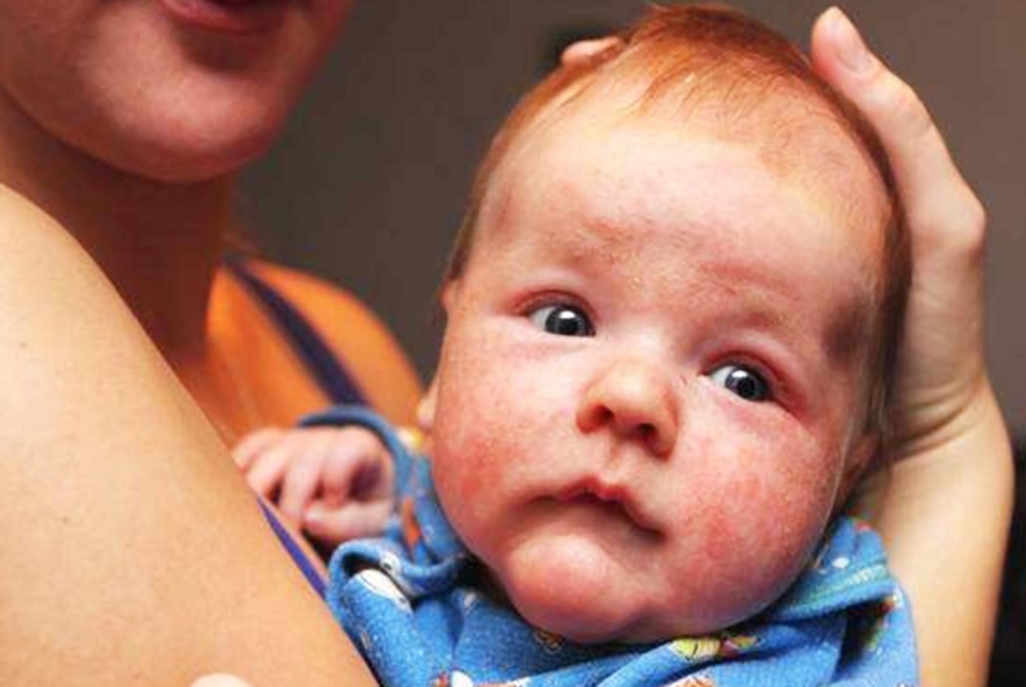 红脸蛋宝宝霜修复,宝宝脸冻伤了发红擦什么