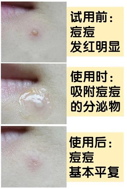 痘坑痘印修复的最佳方法片仔癀,片仔癀抗痘修复贴