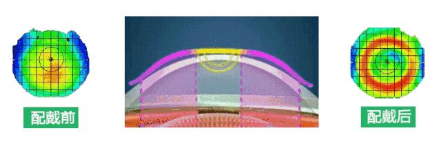真性近视裸眼视力好转是好事吗,近视手术是怎样让眼睛恢复视力的