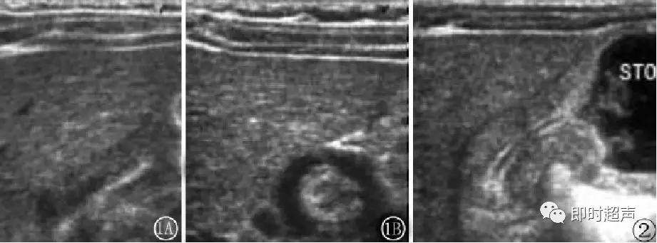 小儿消化道急症超声
