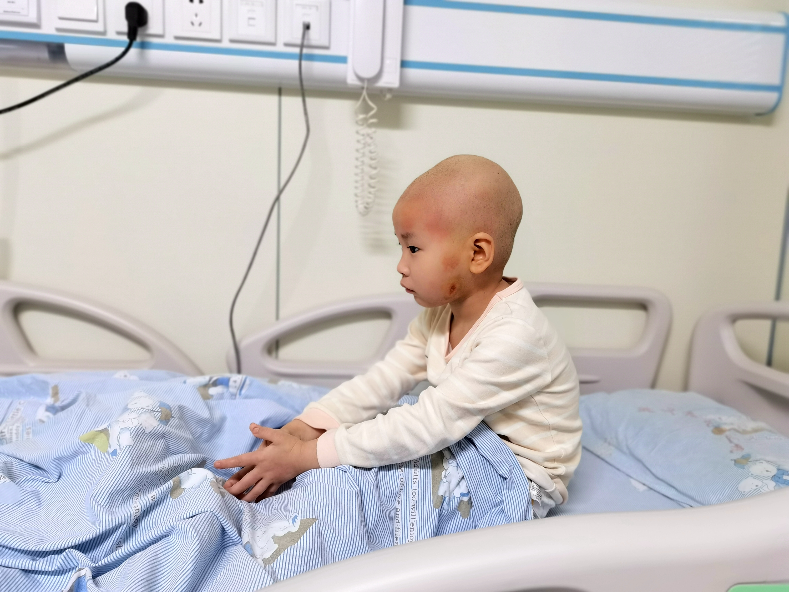 湖北4岁女孩生病致脸部毁容，需“割肉”治疗，爸爸门外放声大哭