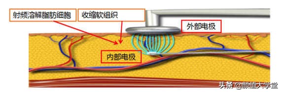 抽脂和吸脂后有什么注意事项,吸脂手术的危害和后遗症