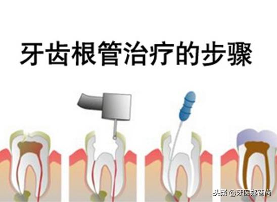 根管治疗后的牙蛀牙怎么办,根管治疗再治蛀牙