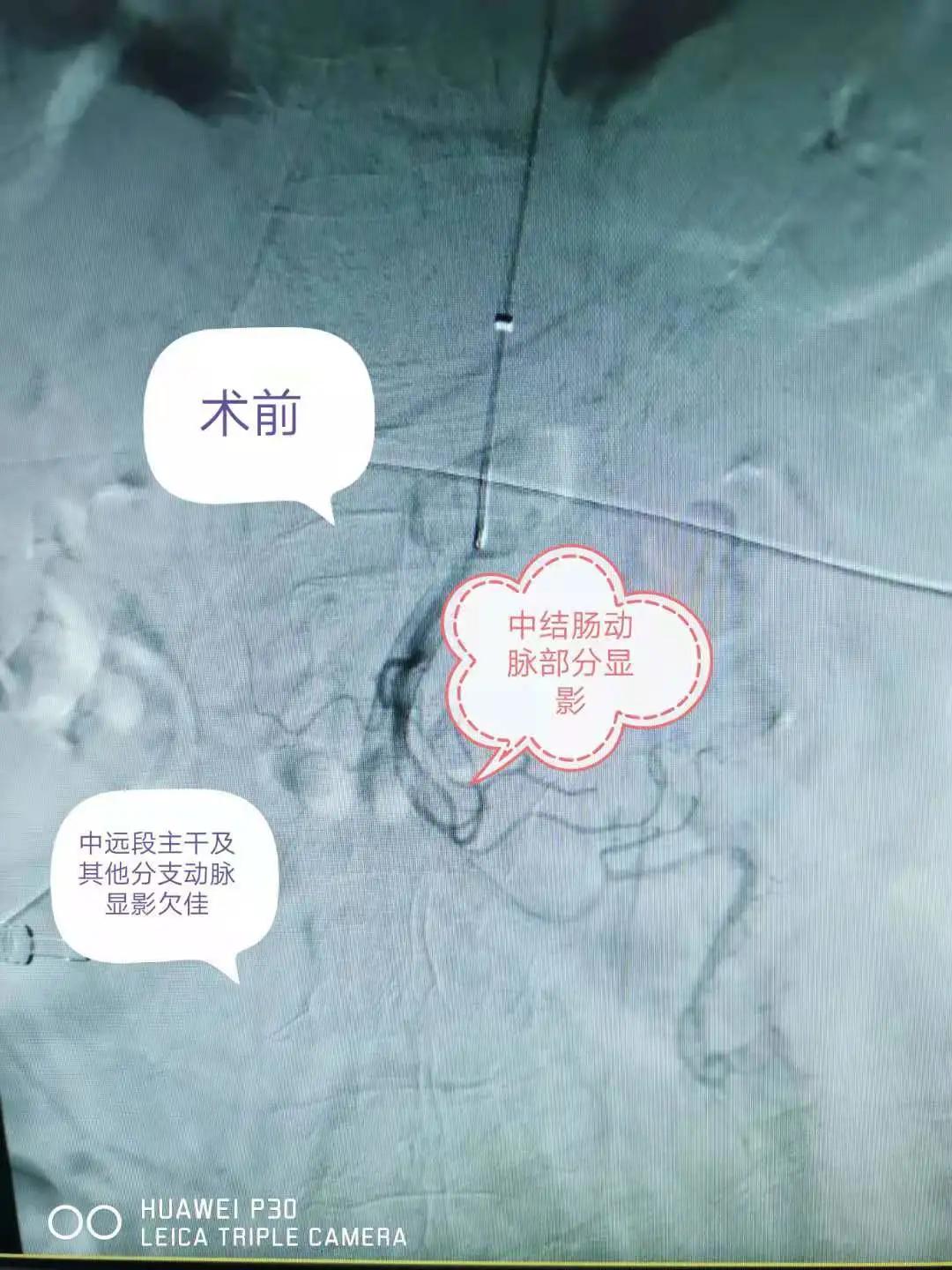 肠系膜动脉栓塞介入治疗,肠系膜下动脉栓塞介入治疗