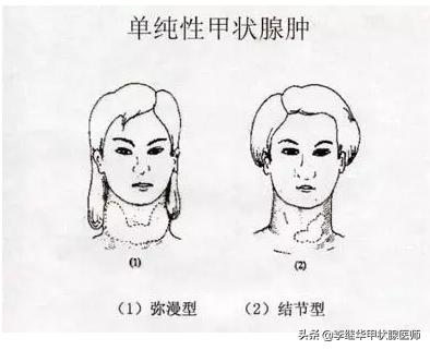 甲状腺球蛋白抗体，过氧化物酶抗体升高？深入浅出解释桥本病