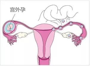 宫外孕什么样的女人最容易得,宫外孕都是女性身体原因吗