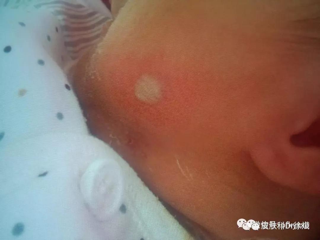 夏季常见皮肤病：脓疱疮（黄水疮）患儿家长必知