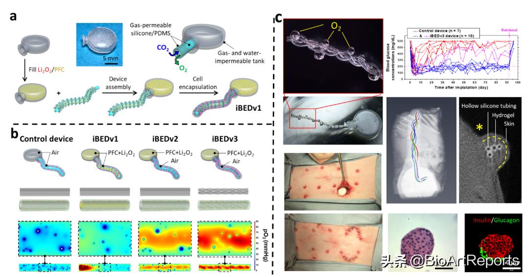 一劳永逸胰腺移植技术治疗糖尿病,胰腺移植治糖尿病的功效